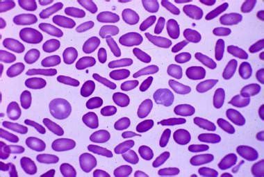 Hereditary elliptocytosis and related disorders .